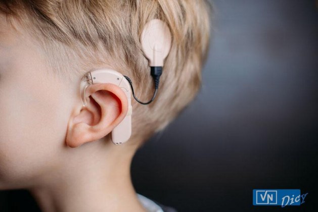 Ốc tai điện tử, thiết bị phục hồi thính lực kể cả điếc bẩm sinh