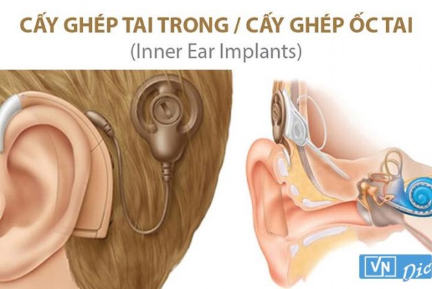 Nên phẫu thuật cấy ốc tai điện tử 1 tai hay cả 2 tai ?